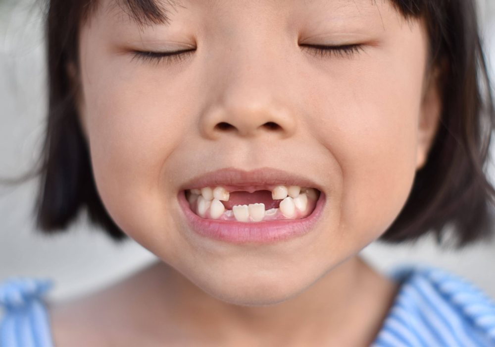cute-little-girl-smile-with-her-broken-tooth-clos-2022-11-04-04-52-30-utc (2) (1)